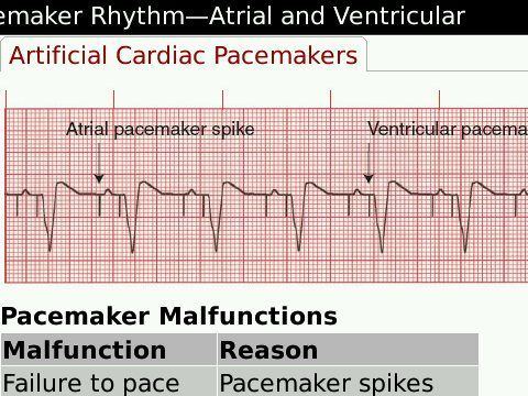 best of Rhythm strip analysis Cardiac