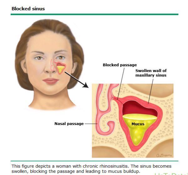 Mizzen reccomend Facial flushing nasal congestion prednisone
