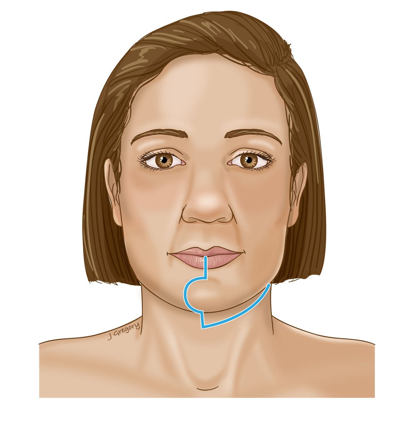 Reconstructive surgery facial jaw post radiation
