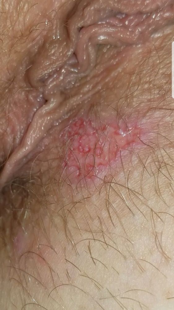 Painful bumps near anus