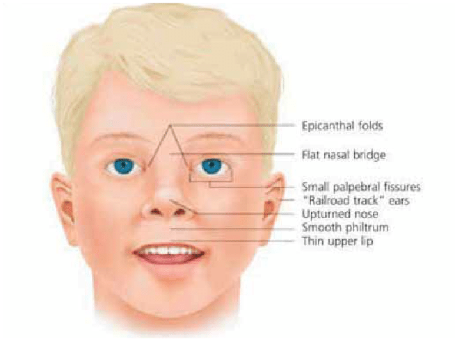 best of Disorders facial alcohol pictures Fetal spectrum