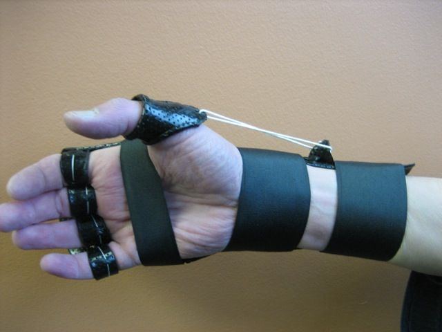 Splint for thumb radial nerve surgery