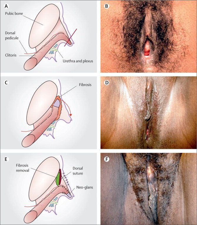 Alien reccomend Circumcised clitoris photos