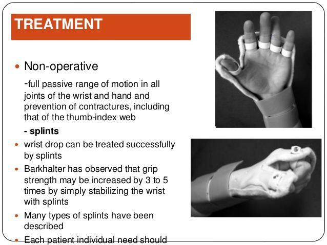 Rosie reccomend Splint for thumb radial nerve surgery
