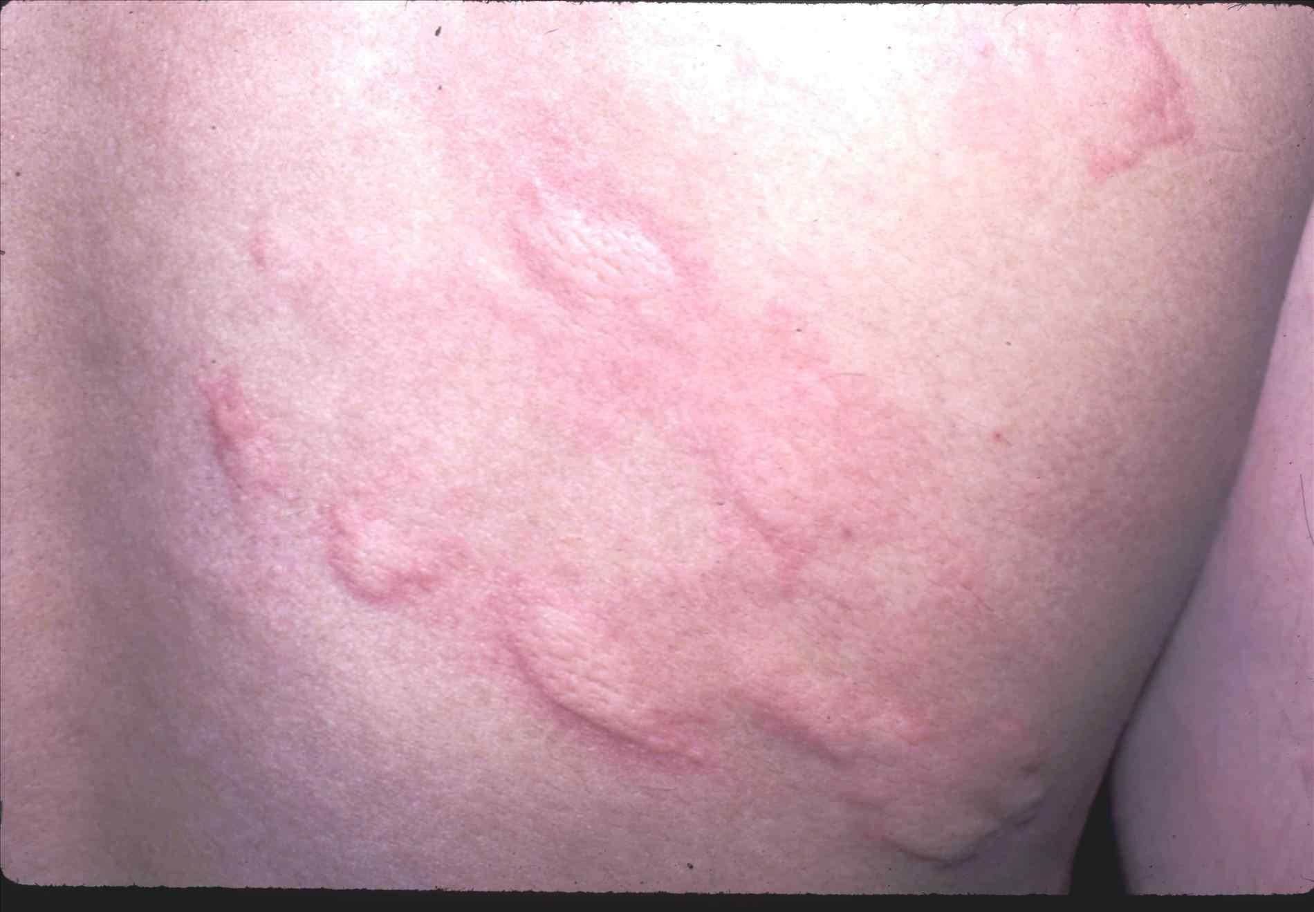Grenade reccomend Facial rash caused by yeast infection
