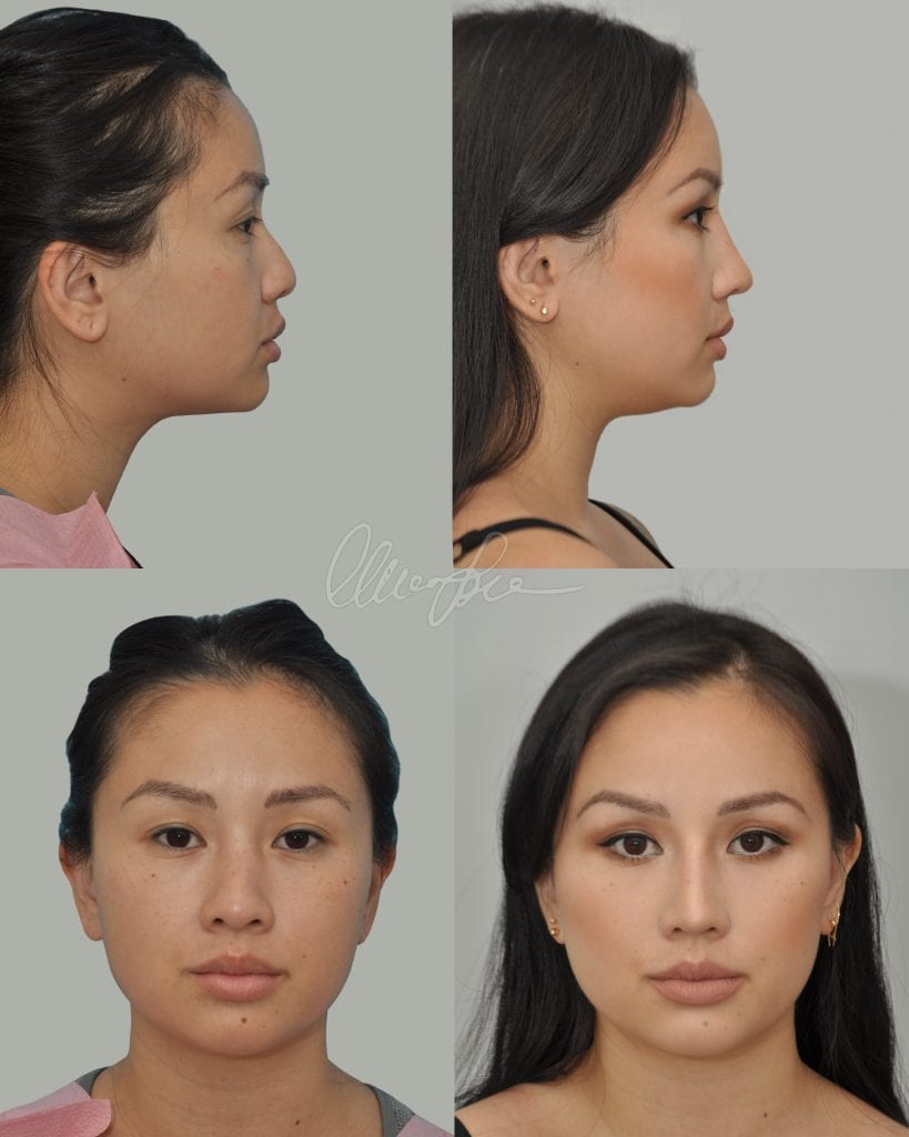 Asian rhinoplasty before and after