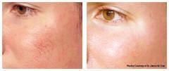 Viper recommend best of facial spider veins Houston