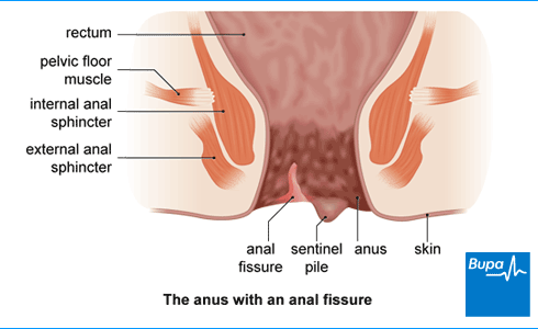 best of Treatment Anal fissure