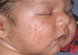 Facial rash caused by yeast infection