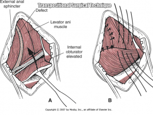Anal attachment flap