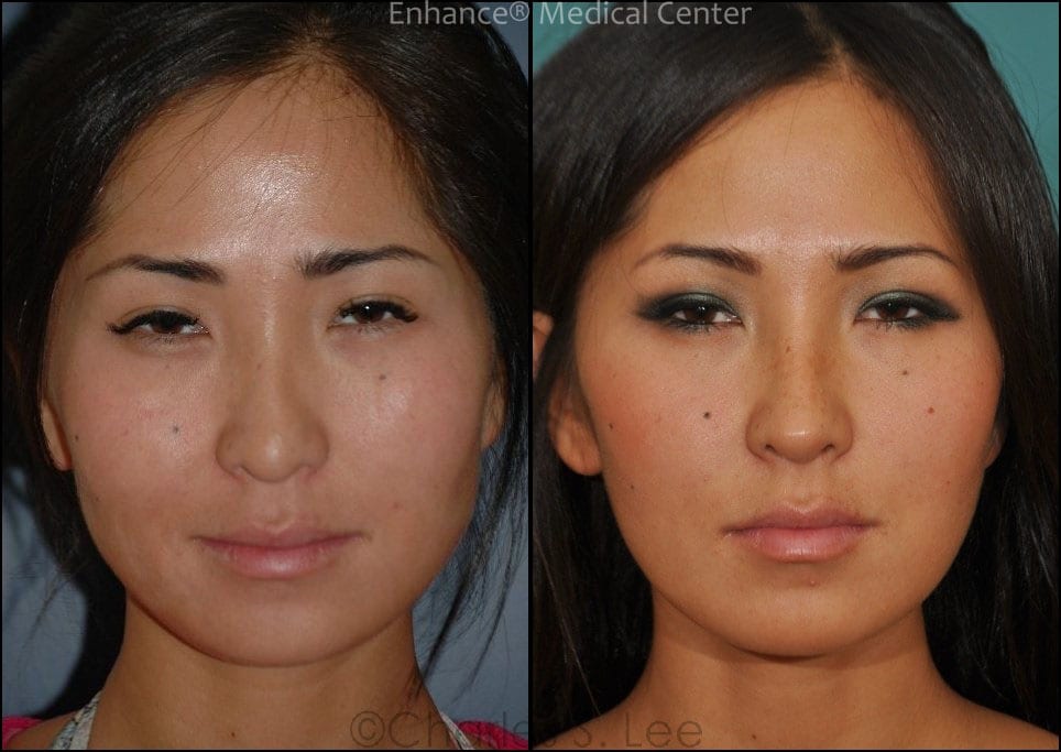 best of Before after and rhinoplasty Asian
