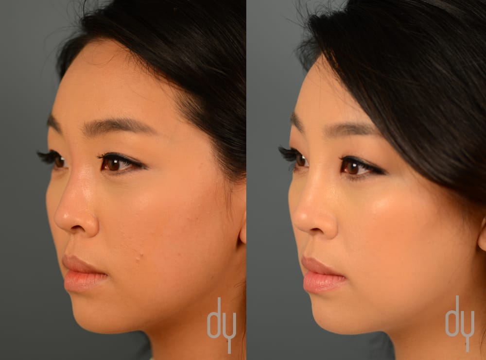 Yellowjacket reccomend Asian rhinoplasty before and after