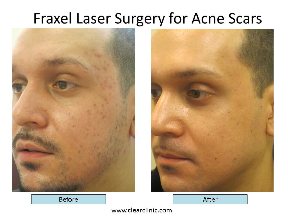 Space G. reccomend Laser treatment for facial scars