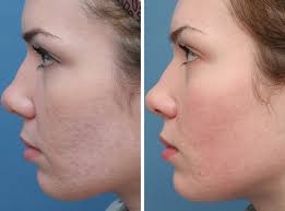 best of Treatment scars facial Laser for