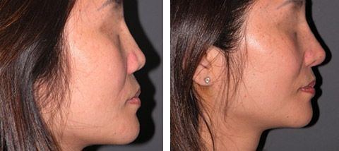 best of Before after and rhinoplasty Asian