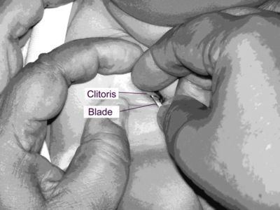 Circumcised clitoris photos - New porn. Comments: 1