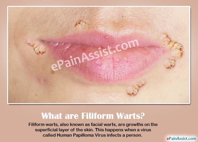 best of Facial warts Cutanious