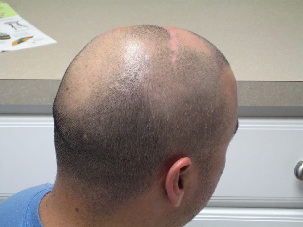 Red T. reccomend Hair Loss Due To Masturbation