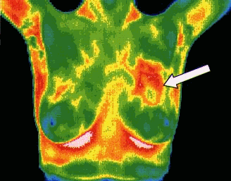 Robin H. reccomend Computerized breast thermal imaging