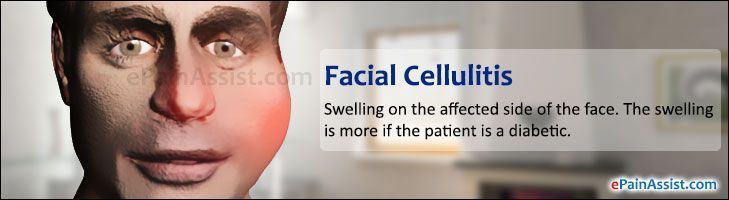 Facial cellulitis images