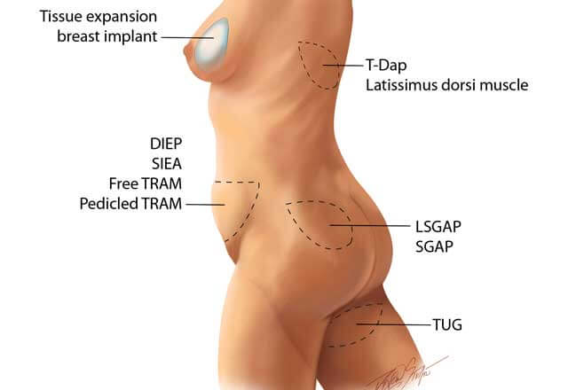 best of Breast the Surgery of