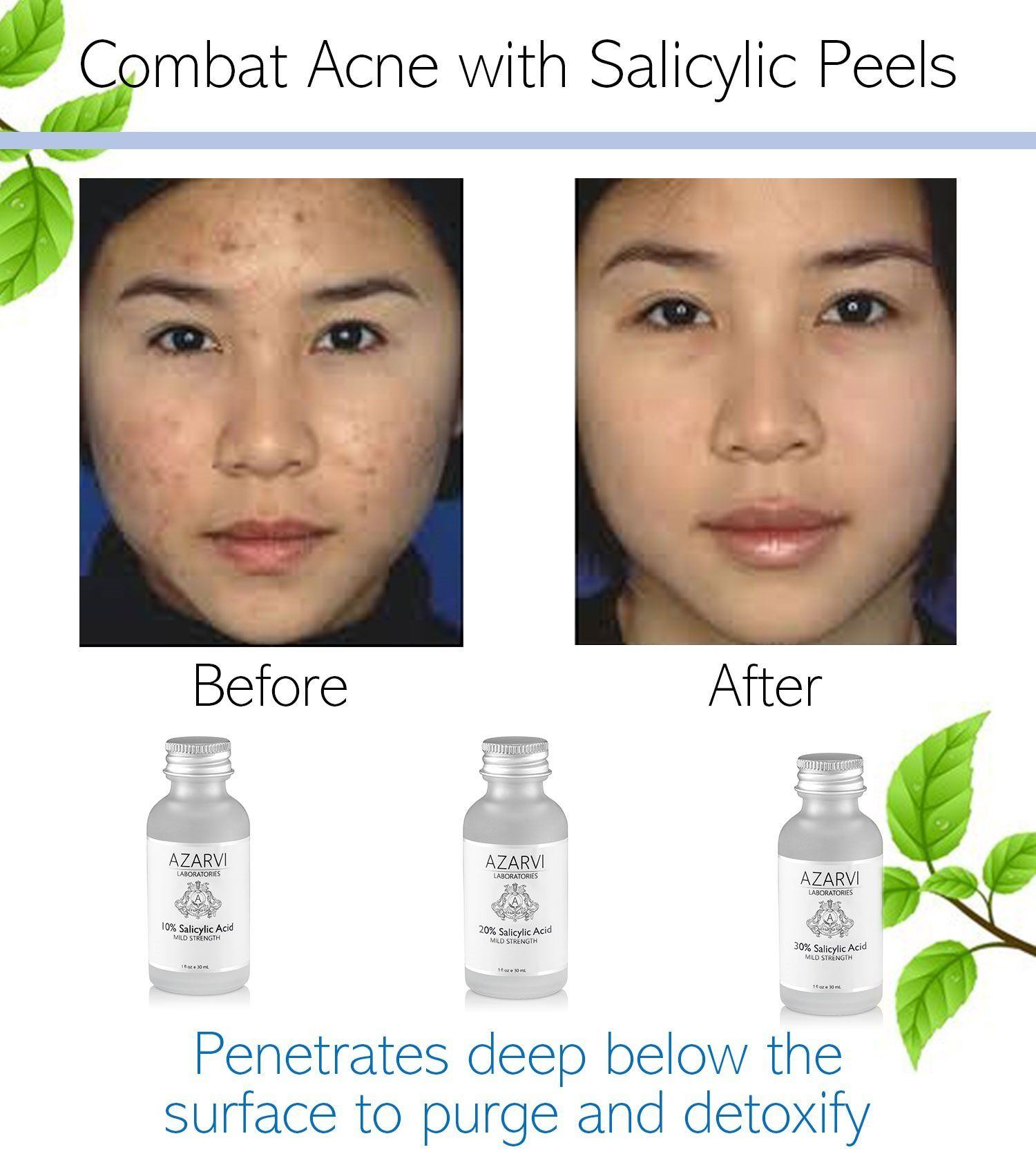 Frost recommendet peel for acne Facial