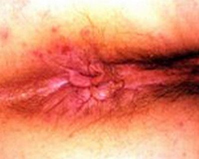 best of Fungal infections Anal