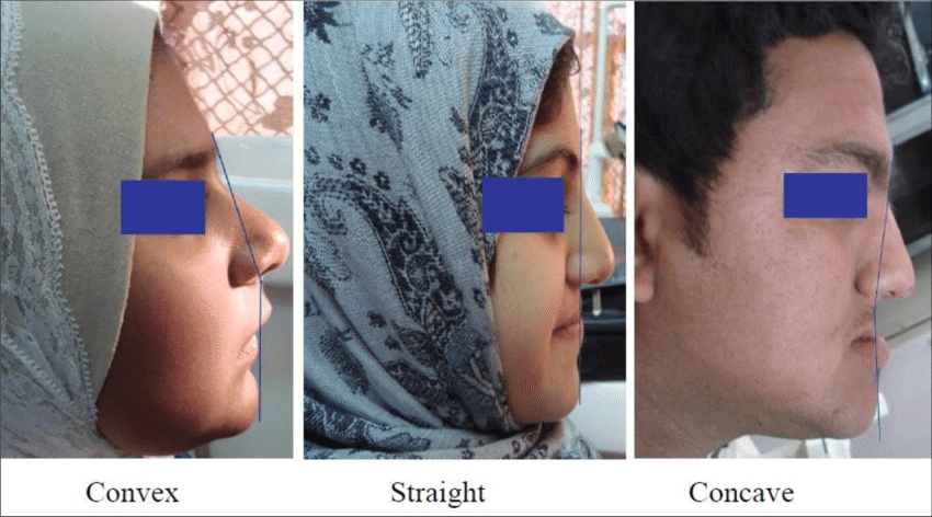 Facial analysis facial profile