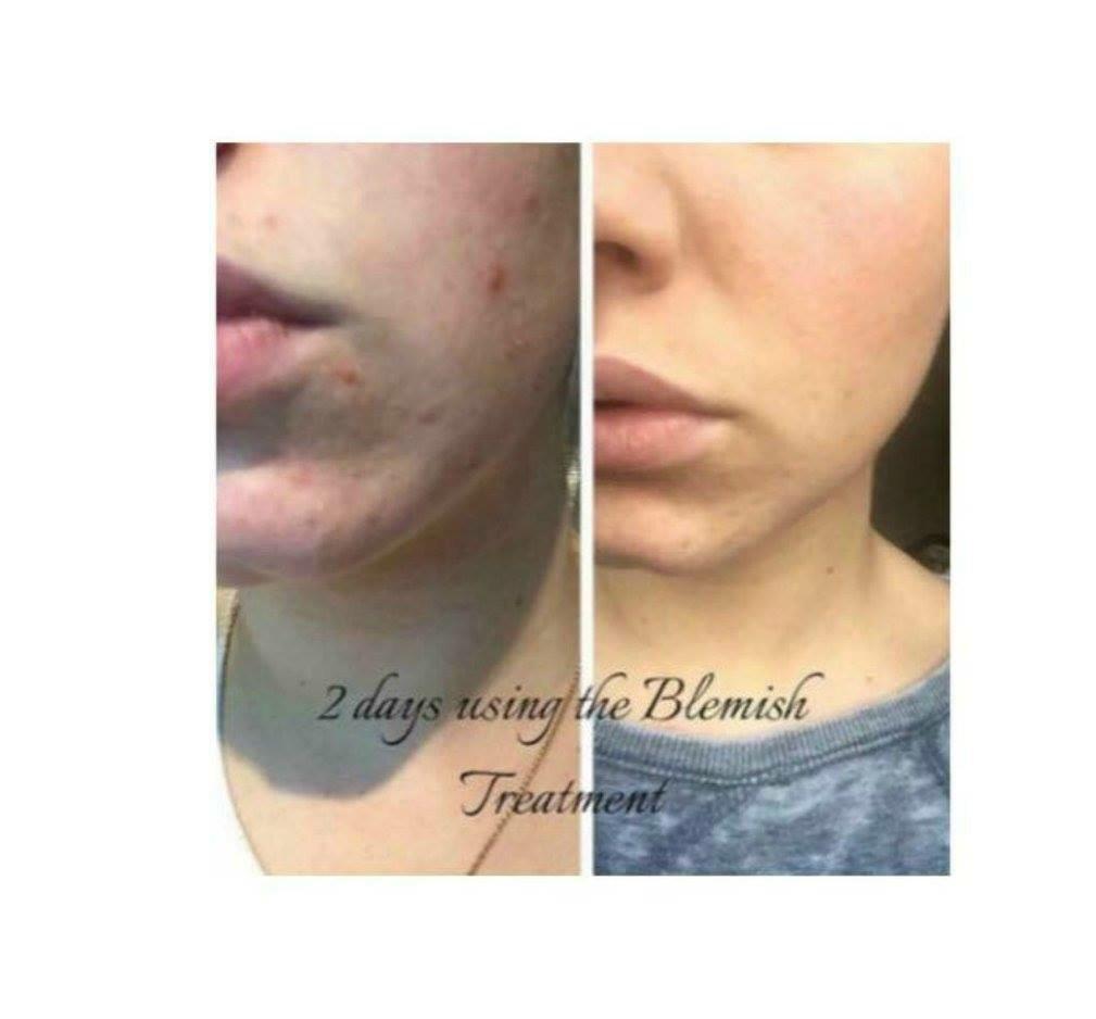 TigerвЂ™s E. reccomend treatments Facial blemish