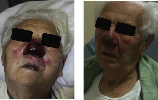 best of Images Facial cellulitis
