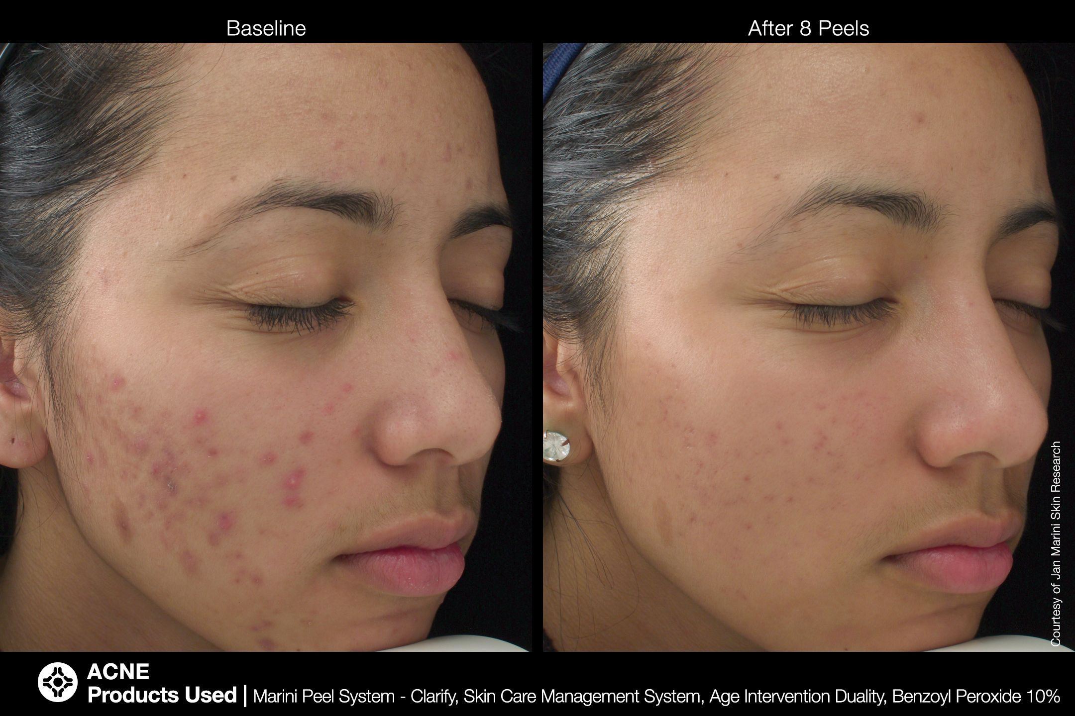 best of For acne peel Facial
