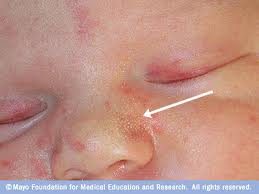 Facial rash caused by yeast infection