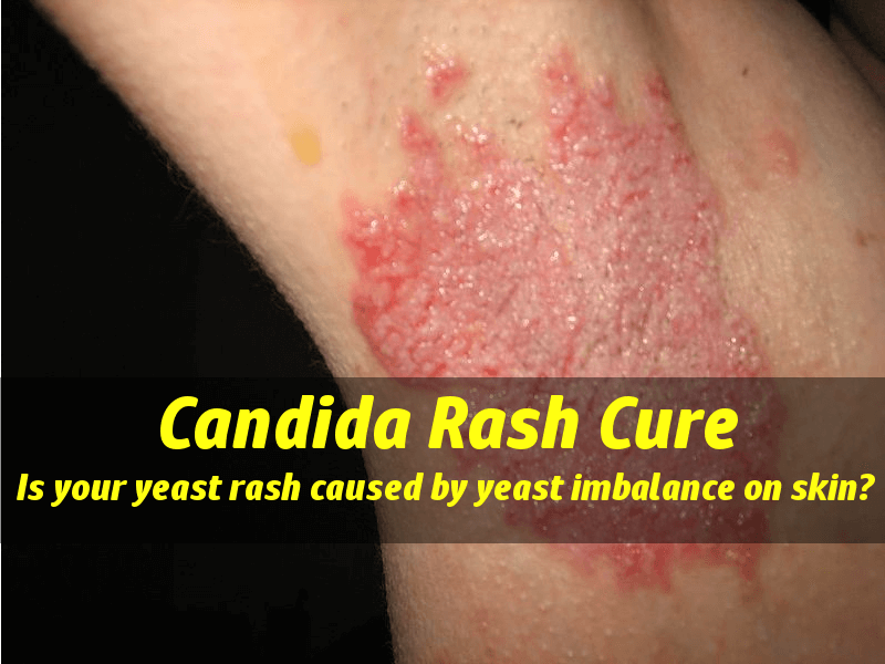 best of Yeast infection by rash caused Facial