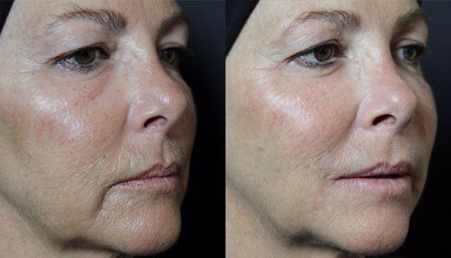 Parallax reccomend Facial spider vein removal brighton and hove east sussex