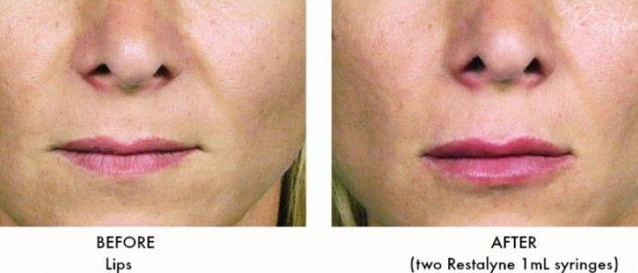 best of Wrinkles restalyn Facial
