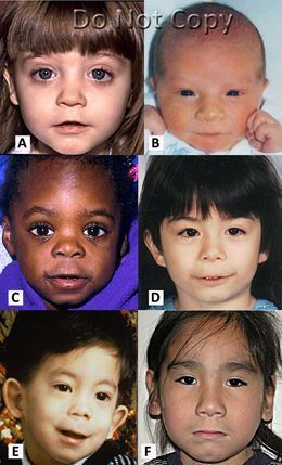 best of Disorders facial alcohol pictures Fetal spectrum