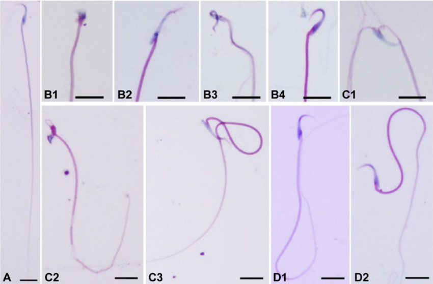 Jetta reccomend Figures of abnormally shaped sperm