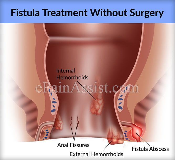 Healing of anal fistula pic