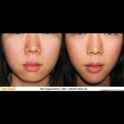 Seasoning reccomend complaints plastic surgery Kim facial