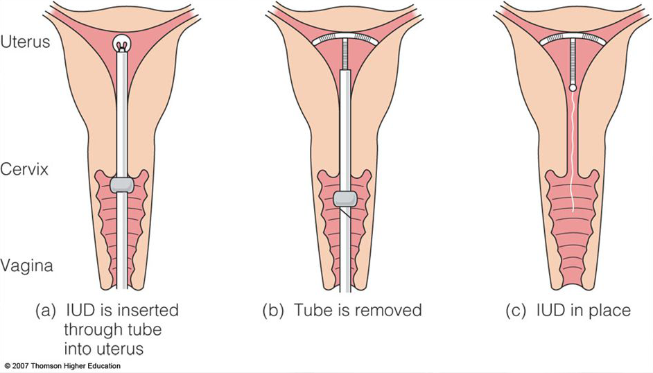 Multiple insertion vagina