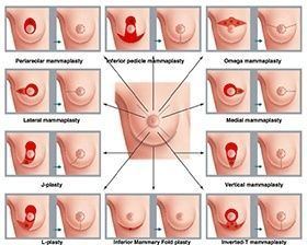 Egg T. reccomend Surgery of the breast